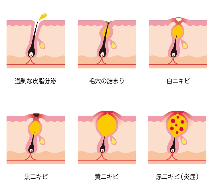 にきびニキビ跡のお悩み解消ケア｜美顔専門美容エステサロンピュア奈良